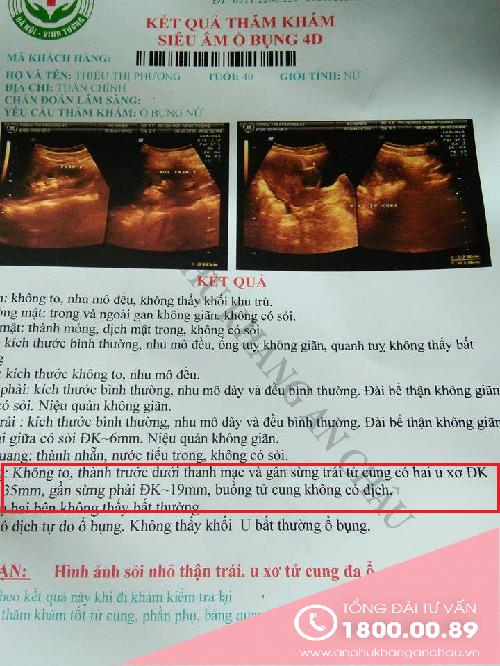 Điều trị đa u xơ tử cung