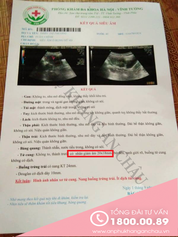 Chữa trị đa u xơ tử cung