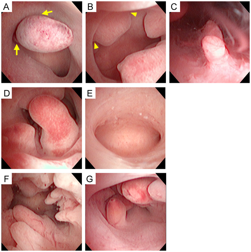 Hình ảnh polyp tử cung