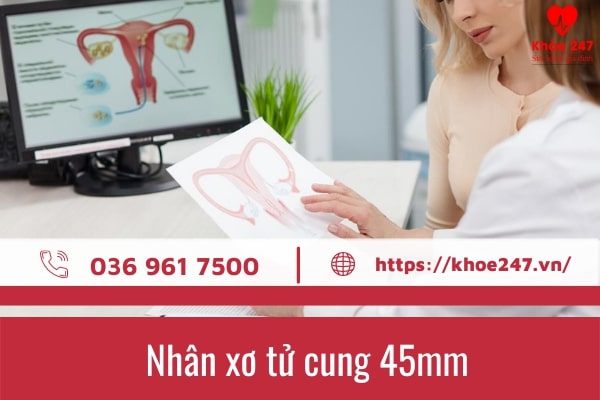 Nhân xơ tử cung 45mm