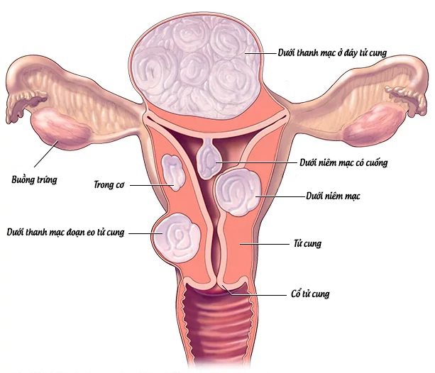 Nhân xơ tử cung có mấy loại theo vị trí