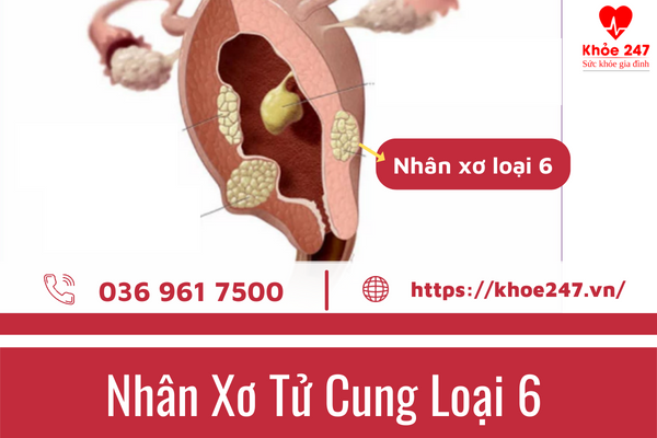 Nhân xơ tử cung loại 6 là gì?