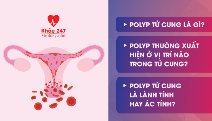 Polyp tử cung là gì?