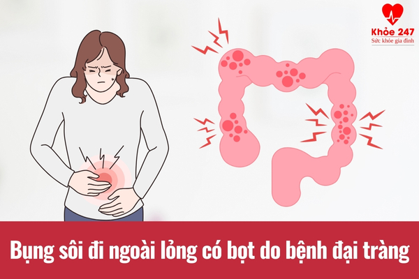 Bệnh đại tràng là nguyên nhân phổ biến gây bụng sôi, đi ngoài lỏng