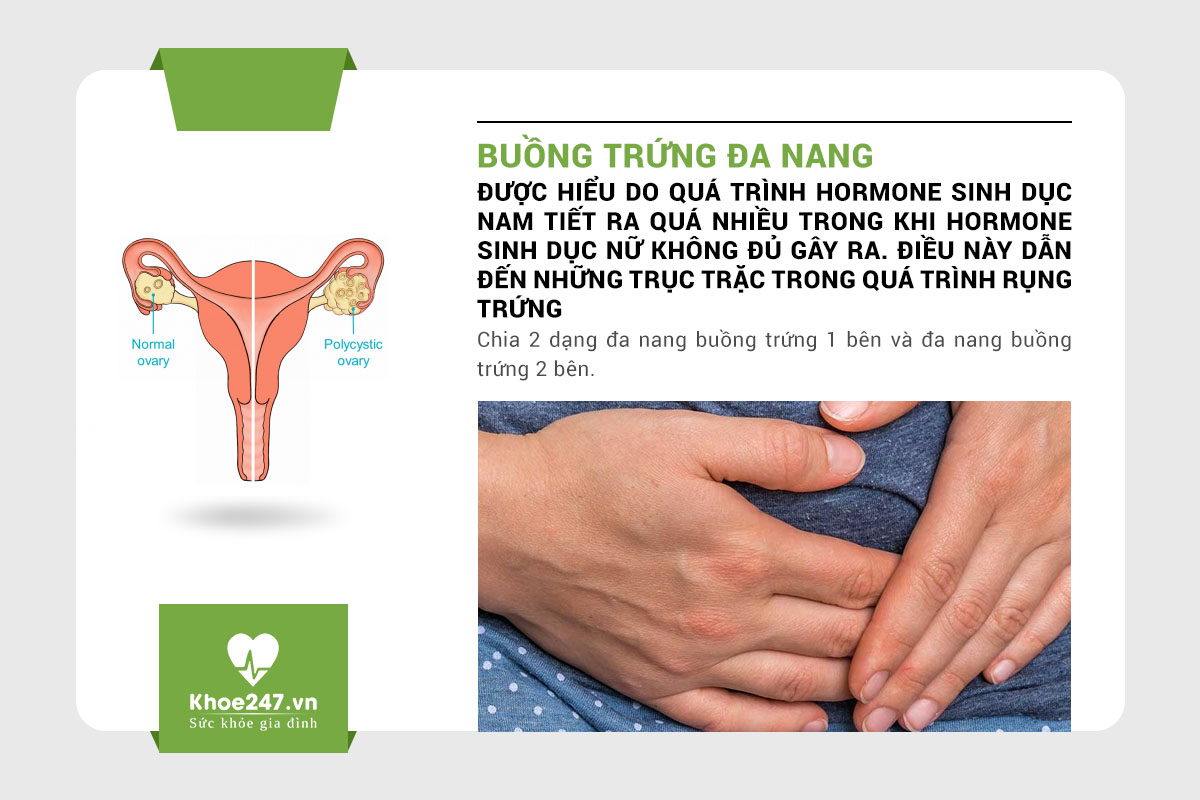 Buồng trứng đa nang là gì