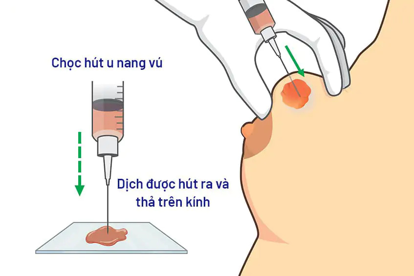 Xử lý u nang vú bằng phương pháp chọc hút dịch