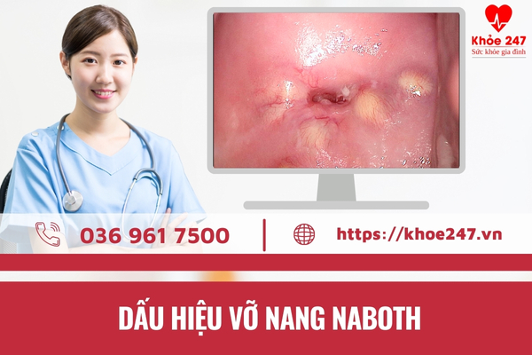 Lưu ý các dấu hiệu vỡ nang naboth cổ tử cung