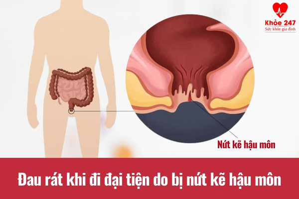 Nứt kẽ hậu môn gây đau rát khi đi đại tiện