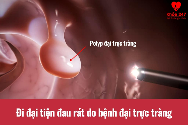 Các bệnh lý tại trực tràng gây tình trạng đau rát khi đi đại tiện