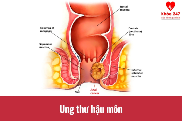 Ung thư hậu môn là nguyên nhân nghiêm trọng nhất gây ra tình trạng đi đại tiện đau rát