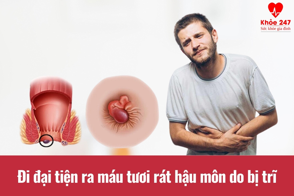 Trĩ gây triệu chứng đi đại tiện ra máu tươi và rát hậu môn