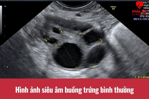 Hình ảnh siêu âm buồng trứng bình thường