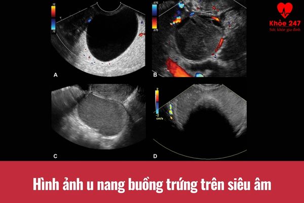 Hình ảnh u nang buồng trứng trên siêu âm