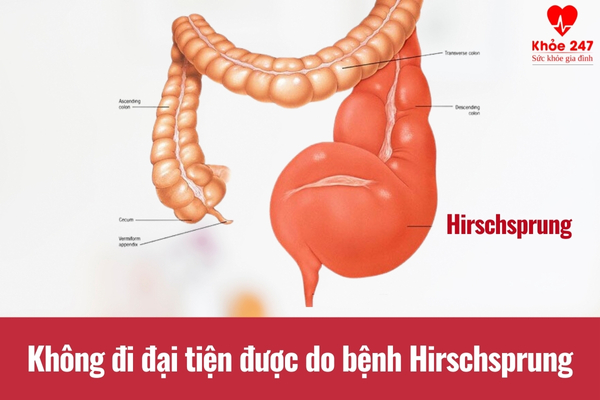 Không đi đại tiện được do bệnh Hirschsprung