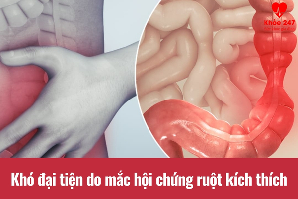 Không đi đại tiện được do hội chứng ruột kích thích