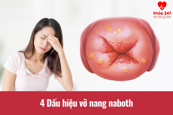 4 dấu hiệu vỡ nang naboth