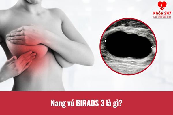 Tìm hiểu nang vú birads 3 là gì