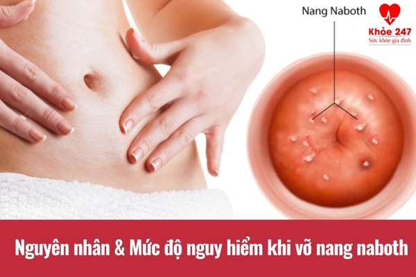 Có nhiều nguyên nhân gây vỡ nang naboth