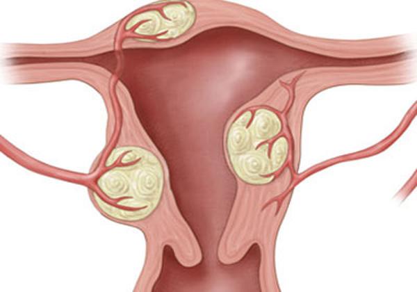 Tác dụng tiêu kết giúp làm tan các khối u