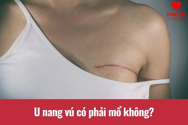 U nang vú có phải mổ hay không còn tùy thuộc vào từng tình trạng bệnh cụ thể