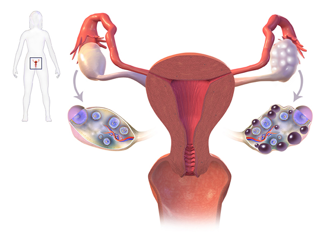 tại sao bị đa nang buồng trứng