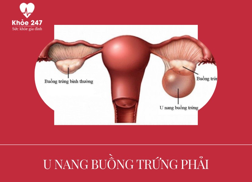 U nang buồng trứng phải