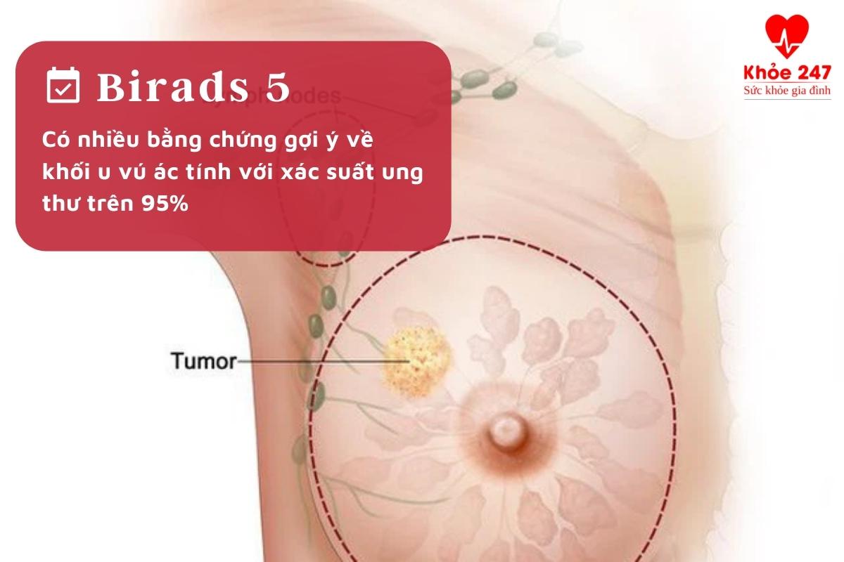 U tuyến vú Birads 5 có nguy hiểm không?