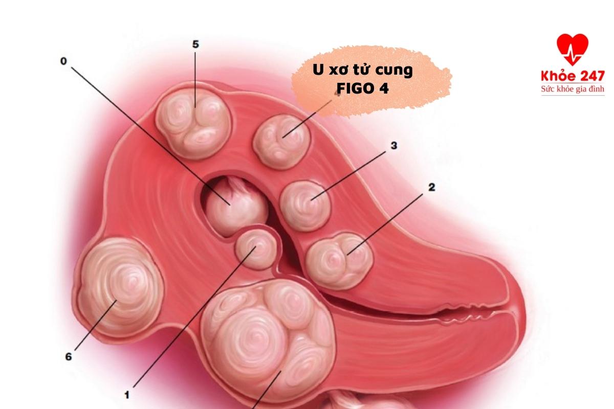 U xơ tử cung loại 4