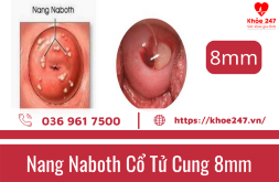 Có nên điều trị nang naboth cổ tử cung kích thước 8mm không?