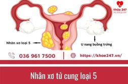 U xơ tử cung loại 5 có ảnh hưởng đến khả năng sinh sản không?
