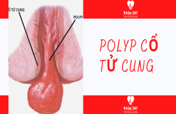 Polyp Cổ Tử Cung là gì? Hình Ảnh, Dấu Hiệu & Điều Trị